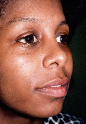 Rhinoplasty 383007