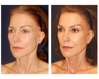 Cheek Augmentation before 415264