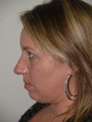 Revision Rhinoplasty 333807