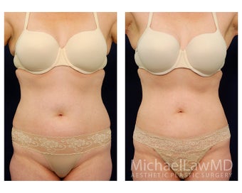 Liposuction before 397201