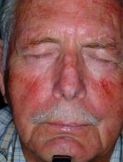 PDT for rosacea before 376120