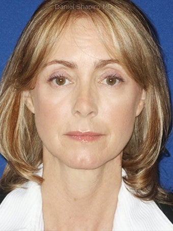 Cheeklift (Minifacelift), Bilateral Upper Blepharoplasty, Periorbital TCA Chemical Peel, Soft Tissue Filler to Nasolabial Folds after 249151