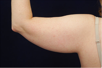 Liposuction 400283