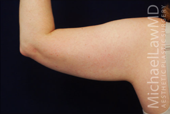Liposuction 400283