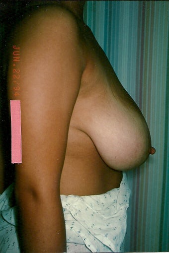 Breast Reduction 401274