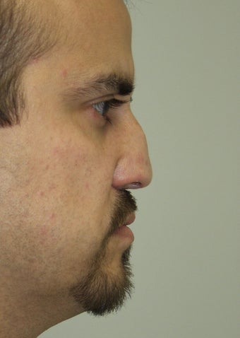 Revision Rhinoplasty 410622