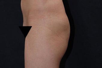 Buttock Augmentation with Gluteal Implant 411237