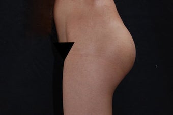 Buttock Augmentation with Gluteal Implant 411237