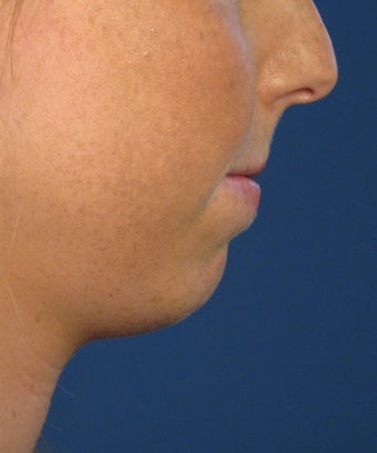 Chin Implant 414153
