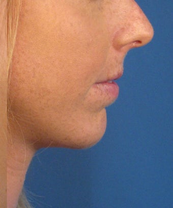 Chin Implant 414153