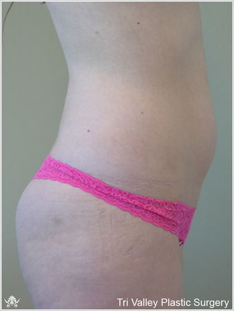 Liposuction 420929
