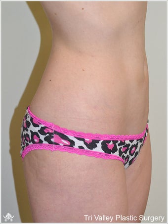 Liposuction 420929