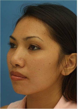 Rhinoplasty 421673