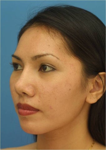 Rhinoplasty 421673