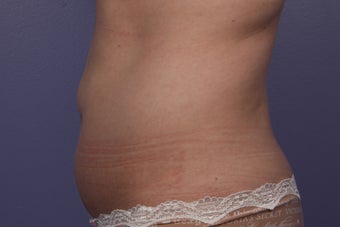 CoolSculpting to Abdomen 429672