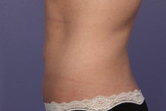 CoolSculpting to Abdomen 429672
