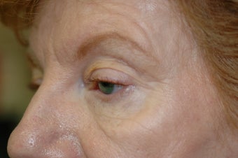 Midface Lift, upper and lower eyelid surgery 433477