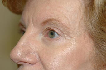 Midface Lift, upper and lower eyelid surgery 433477