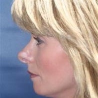 Revision Rhinoplasty 442999