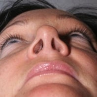 Revision Rhinoplasty 443003