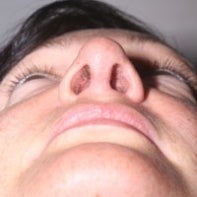 Revision Rhinoplasty 443003