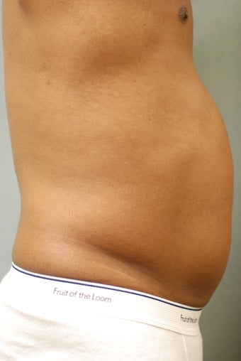 SmartLipo™ Restoration of a Male's Abs 450440