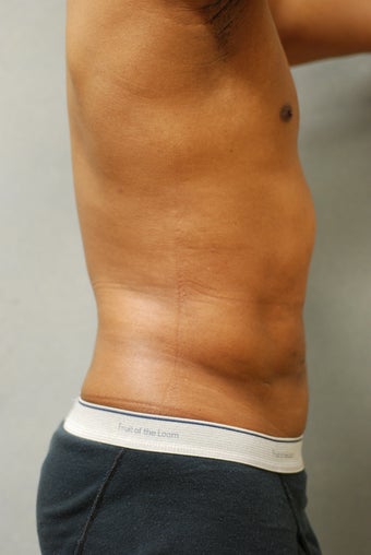SmartLipo™ Restoration of a Male's Abs 450440