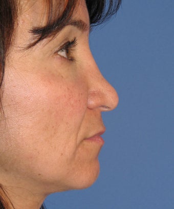 Revision Rhinoplasty 454238