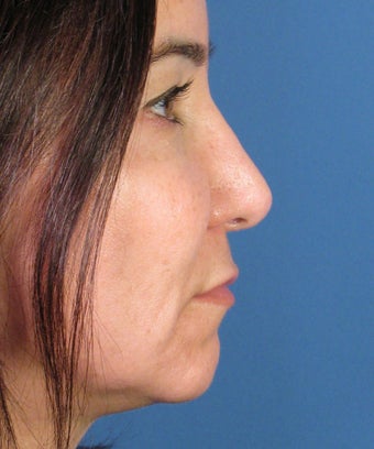 Revision Rhinoplasty 454238