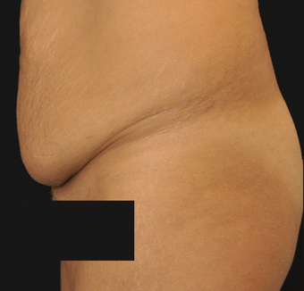 Abdominoplasty 458932
