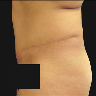 Abdominoplasty 458932