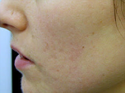 Fractional laser used to treat acne scars 460041