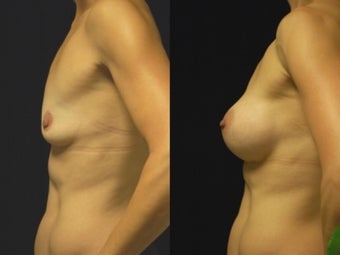 Breast augmentation, gel implants 462159