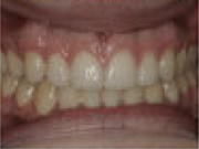 Damon System Braces 477296