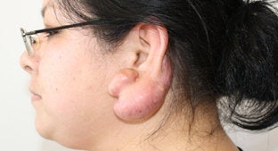 Ear lobe Keloid 494478