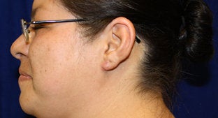 Ear lobe Keloid 494478