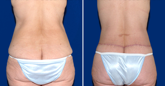 Lower Body Lift 495816