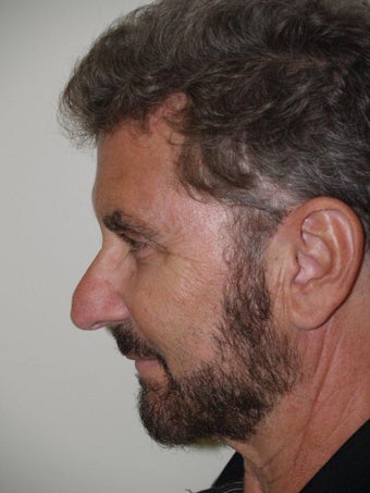 Rhinoplasty 495965