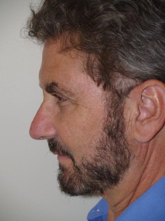 Rhinoplasty 495965