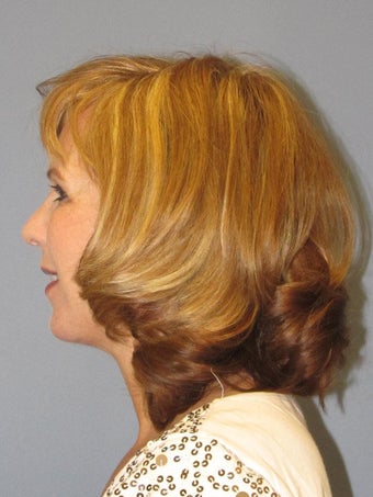 Mini Facelift - LiteLift™ 499887