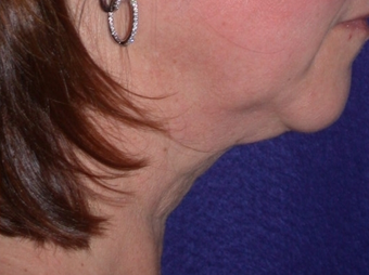 Necklift 208441