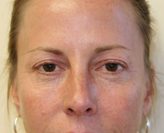 Upper and Lower Eyelids before 269089