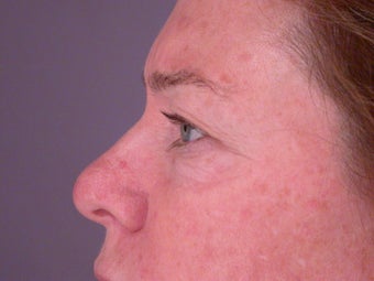 Eyelid Surgery before 306450