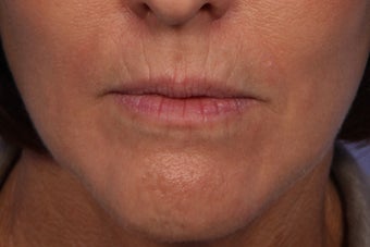 Botox and Juvederm Ultra Plus to Upper Lip before 308354