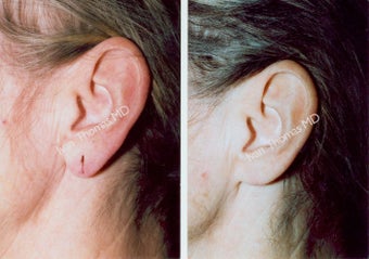 Earlobe Surgery before 243332
