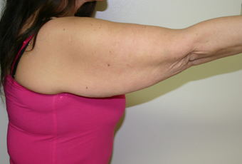 Brachioplasty (Arm lift) before 263698