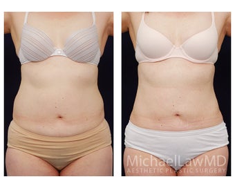 Liposuction before 495477