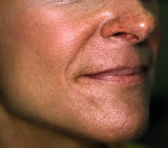 Correction of Facial Aging Grooves before 157594