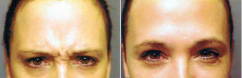 Botox before 575411