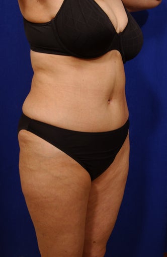 Abdominoplasty with liposculpture of abs and flanks after 82412
